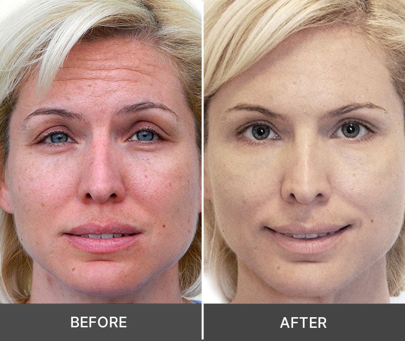 Idrotherapy before and after